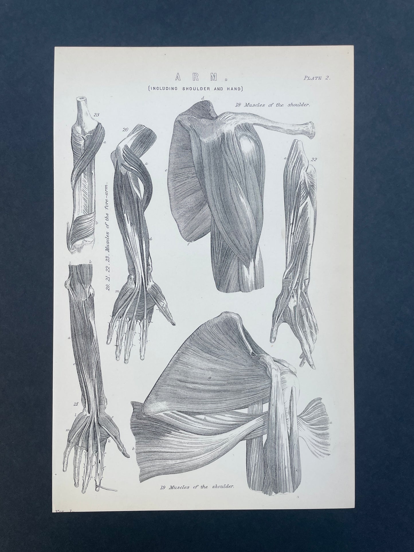 Antique Book Plate – 19th Century Dislocations Human Anatomy Illustration  – Original Engraving