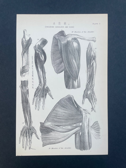 Antique Book Plate – 19th Century Dislocations Human Anatomy Illustration  – Original Engraving
